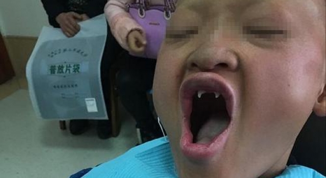 少年患病似吸血鬼:长有獠牙且畏光!