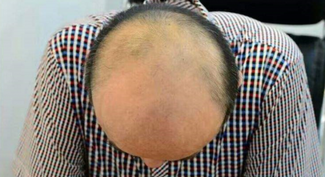 脱发更长寿上热搜 网友:我宁肯早死