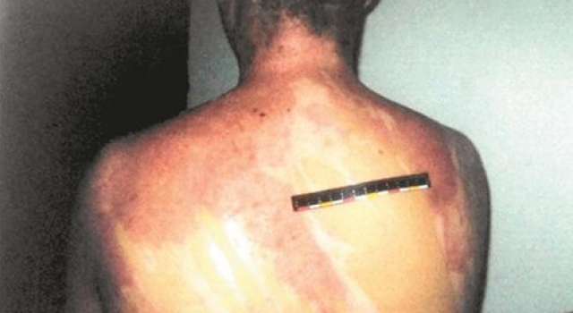 男子熟睡遭妻子泼滚烫花生油致毁容 认为丈夫出轨报复他