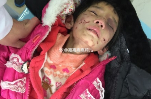 5岁女童校外托管全身是伤 老师劝家长:这种孩子不要了