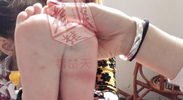 3岁女孩称幼儿园老师用牙签扎脚底 校方否认：蚊子咬的