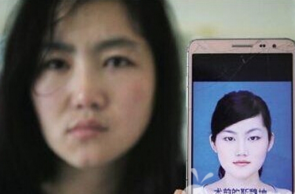 男子学习整形5天 为女子打玻尿酸隆鼻打到血管致失明