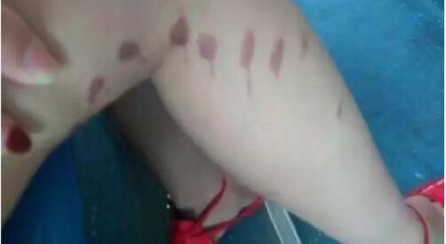 可怕!多名短裙女生被泼不明液体 刺痛留疤或为强酸