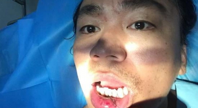 王宝强嘴缝10针 宝宝不哭！那些明星们受过的伤
