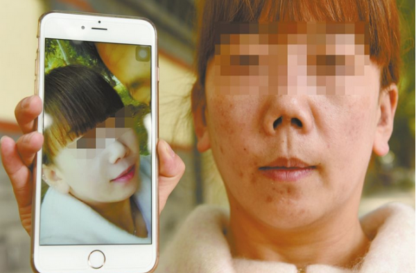女子花6万整成朝天鼻 本只想美眼袋被忽悠做全套