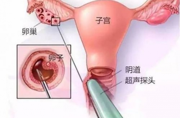 女大学生卖卵20颗秒换苹果7？卖卵子黑中介内幕大揭秘