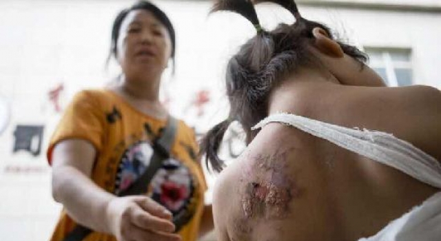 2岁女童尿裤子 舅妈喷热水惩罚11小时后休克死亡