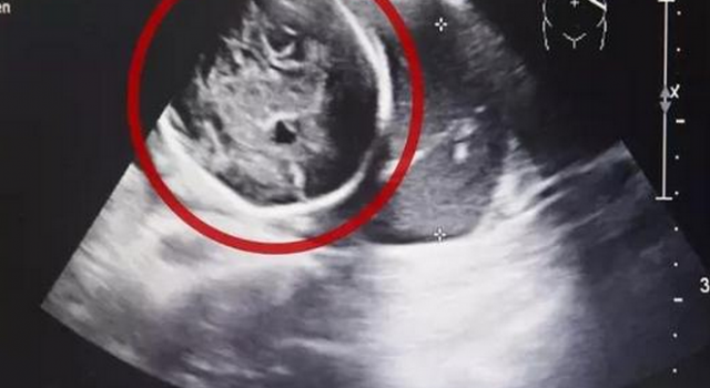 怀孕6月子宫为空怎么回事？结果让人震惊....