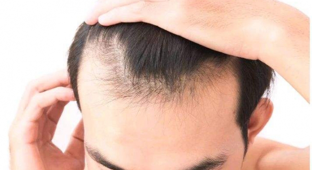 医生证明90后真秃了 精神因素是脱发的催化剂