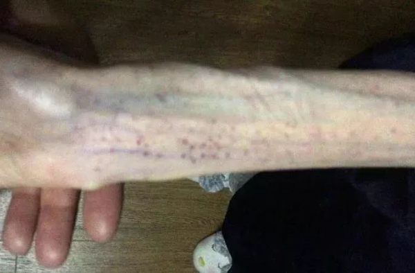 女孩减肥剩50斤（图）瘦成植物人堪比自杀！为什么这么瘦？