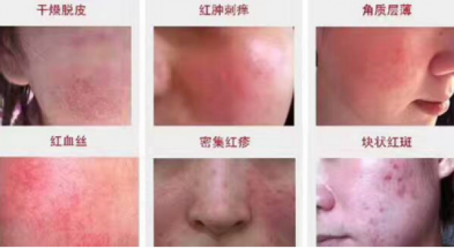 激素脸一直不好怎么办 激素脸最好的治疗方法