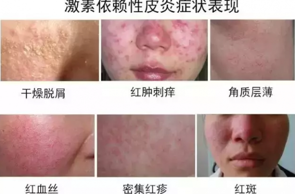 激素脸戒断期多久消失 如此治疗激素脸才能治得好