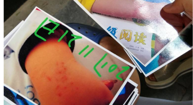男童遭老师背摔 幼儿园一男童因趴老师肩头 被老师背摔