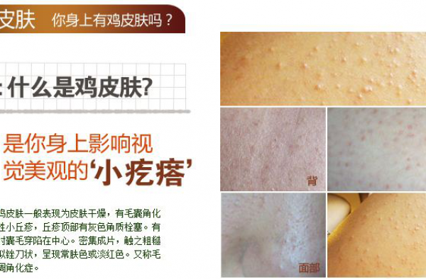 鸡皮肤怎么快速消除，去鸡皮肤最有效的方法大全