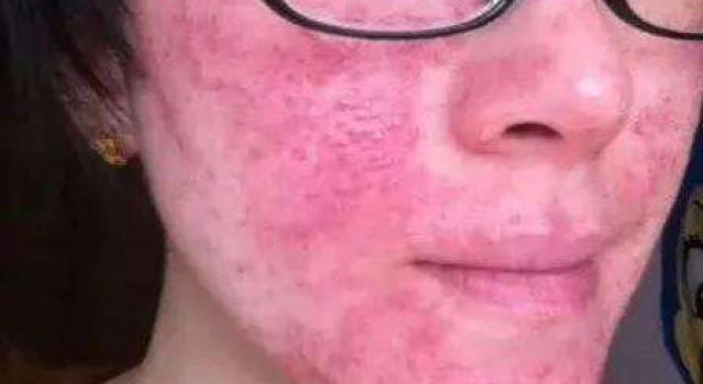 激素脸反跳是什么意思 那么激素脸反跳期怎么护理