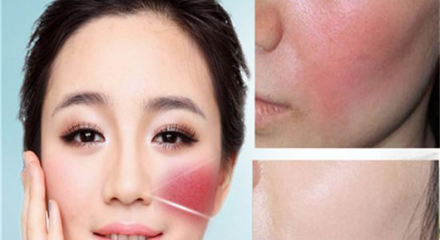 脸上红血丝怎么消除，修复红血丝如何选对产品？