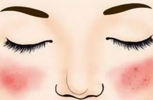 怎么判断是不是激素脸？那么激素过敏脸能自愈吗