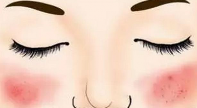 激素脸皮肤薄脸容易红怎么办？激素脸用什么曾厚角质层