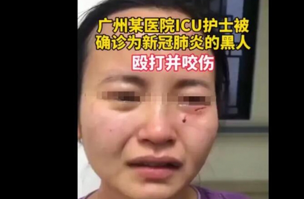 邓主任回应外籍新冠患者咬伤护士 网友：官腔打得可以
